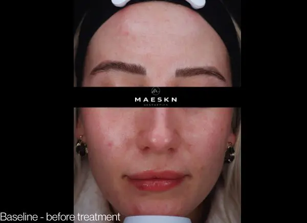 rosace before and after picture baseline