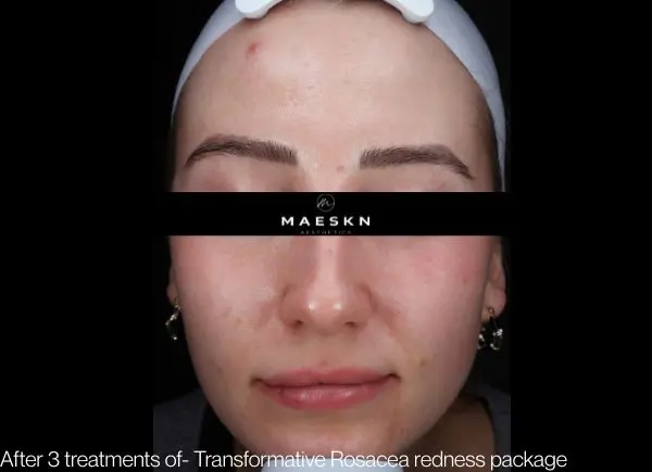 rosace before and after picture - after picture of rosacea redness package after 3 treatments