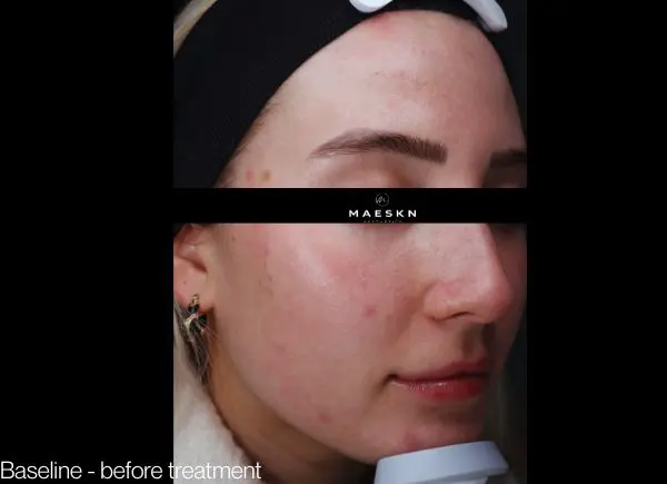 before and after baseline side profile