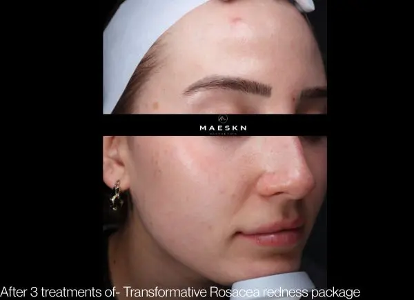 before and after - redness and rosacea package 3 treatments after photo