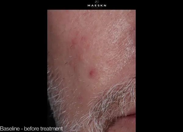 before pic vascular lesion removal