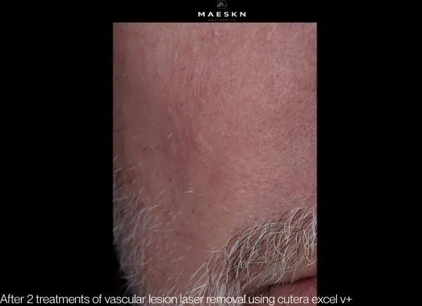 after 2 treatments cutera excel v+ for vascular lesion removal