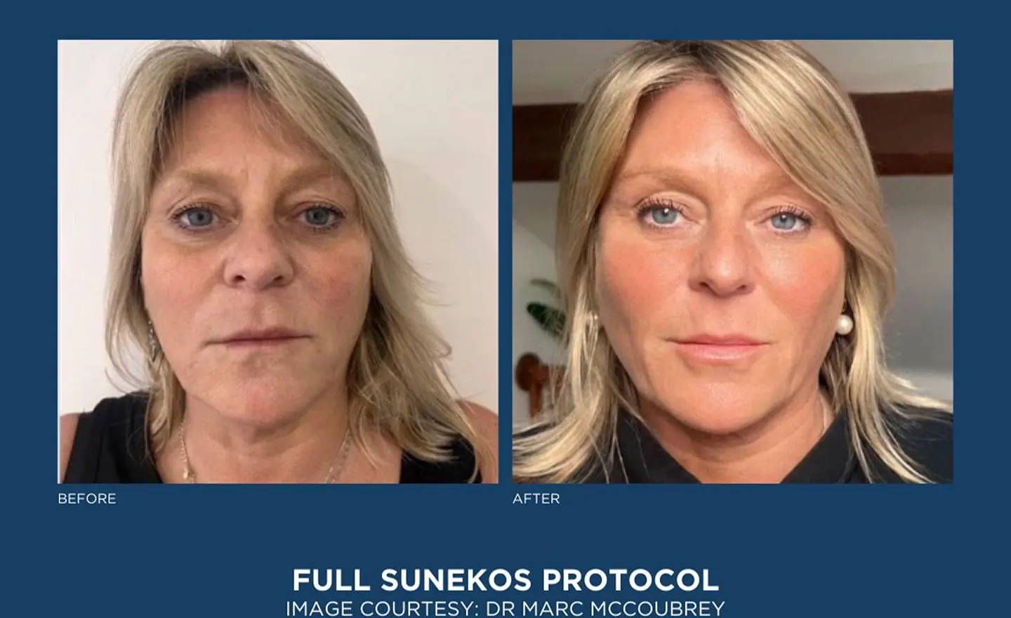 SUNEKOSE 1200 BEFORE AND AFTER