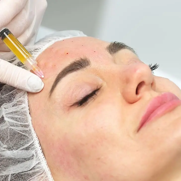 skin booster injections