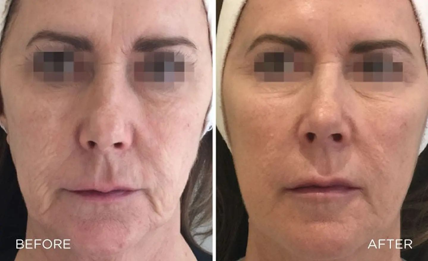 profhilo before and after