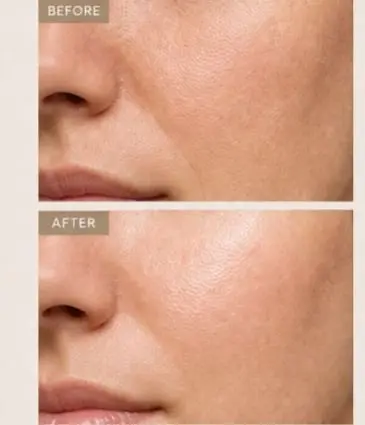 before and after prfhilo