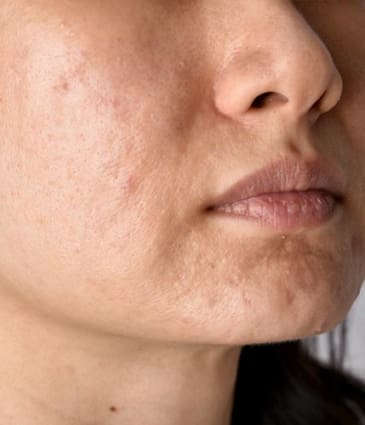 MAESKN Aesthetics - Acne Scarring