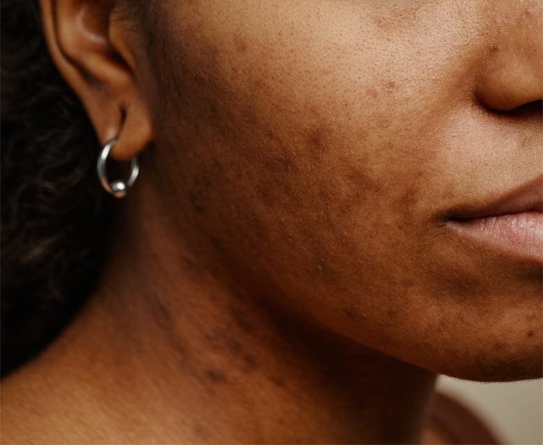 MAESKN Aesthetics - Acne Scarring