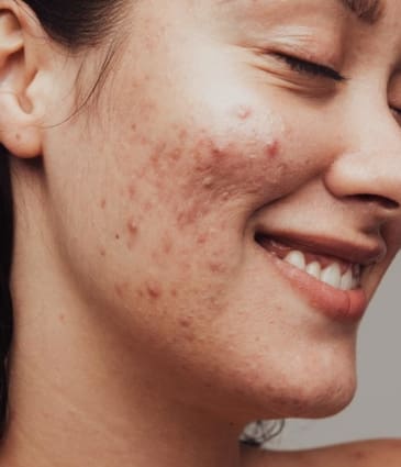 MAESKN Aesthetics - Active Acne