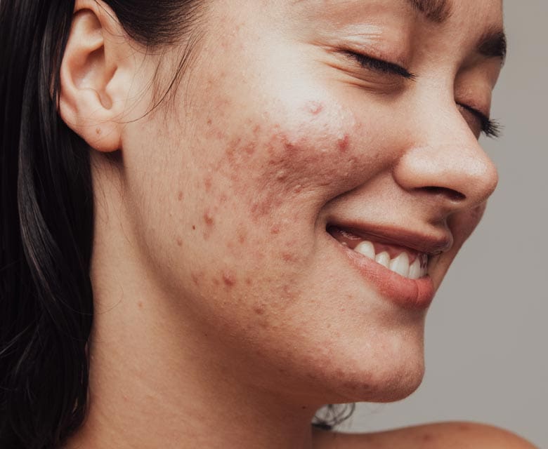 MAESKN Aesthetics - Active Acne