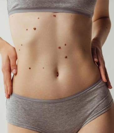 MAESKN Aesthetics - Benign Skin Lesions