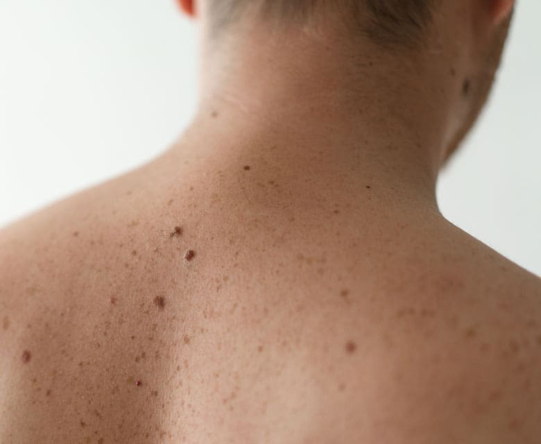 MAESKN Aesthetics - Benign Skin Lesions