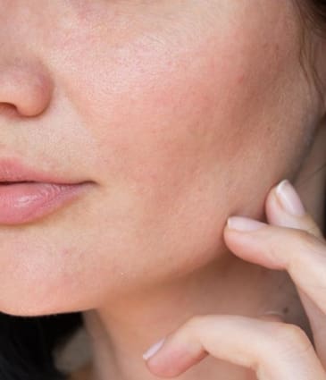 MAESKN Aesthetics - Dry Skin