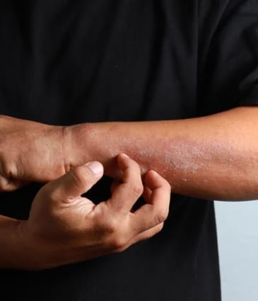 MAESKN Aesthetics - Eczema