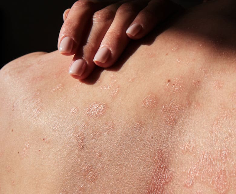 MAESKN Aesthetics - Eczema