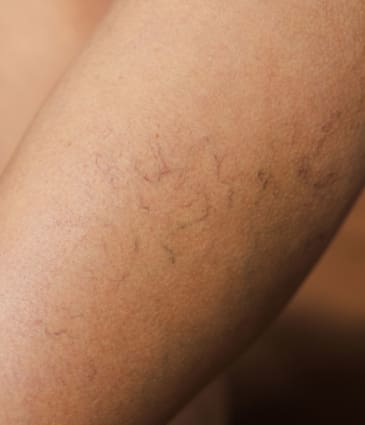 MAESKN Aesthetics - Leg Veins - Spider & Reticular