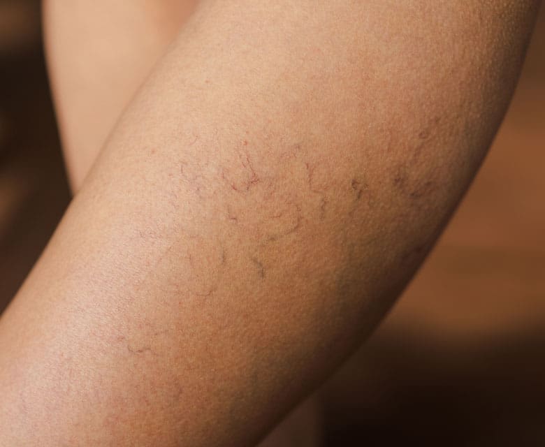 MAESKN Aesthetics - Leg Veins - Spider & Reticular