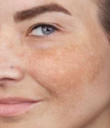 MAESKN Aesthetics - Melasma