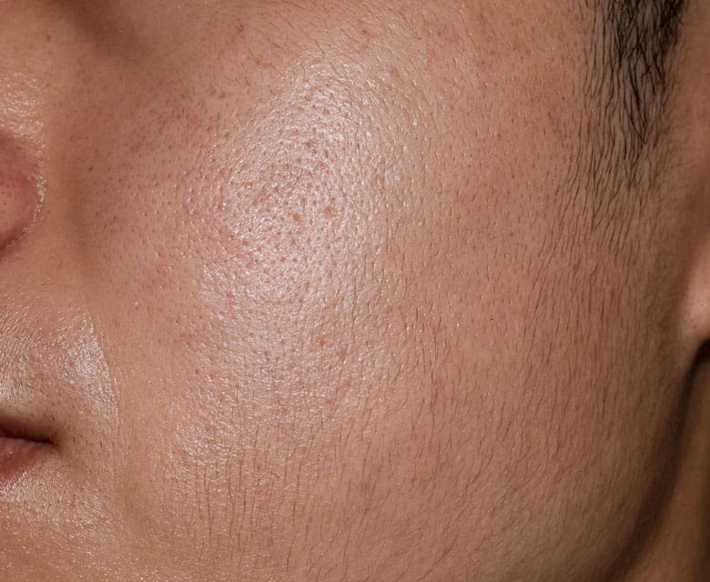 MAESKN Aesthetics - Open & Enlarge Pores