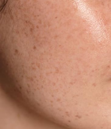 MAESKN Aesthetics - Pigmentation & Sun Damage