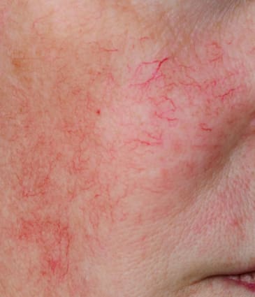 MAESKN Aesthetics - Redness & broken thread veins