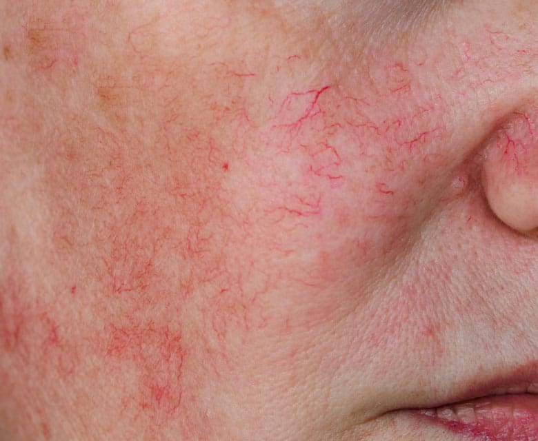 MAESKN Aesthetics - Redness & broken thread veins