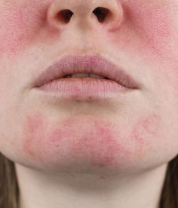 MAESKN Aesthetics - Rosacea