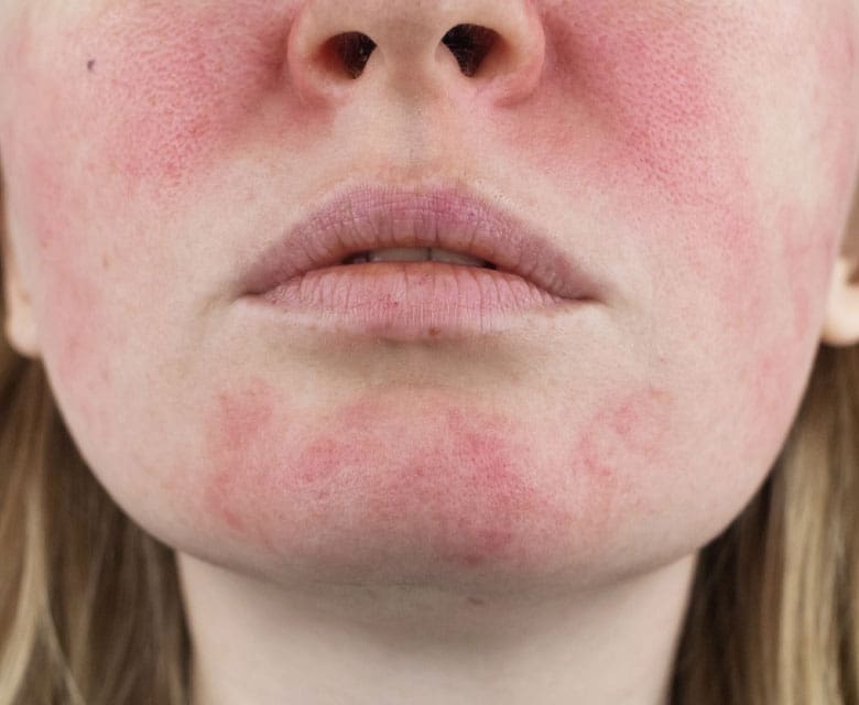 MAESKN Aesthetics - Rosacea