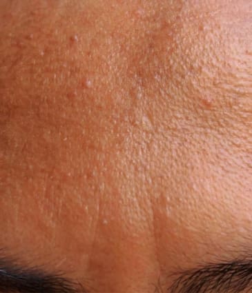 MAESKN Aesthetics - Sebaceous hyperplasia