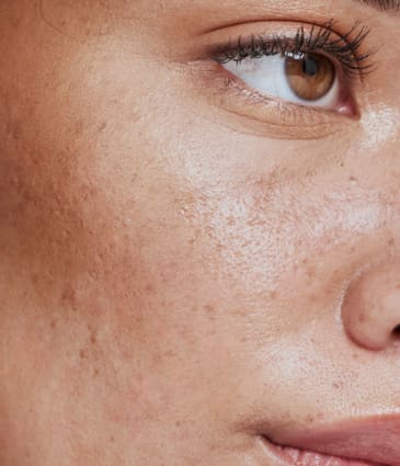 MAESKN Aesthetics - Sebaceous hyperplasia