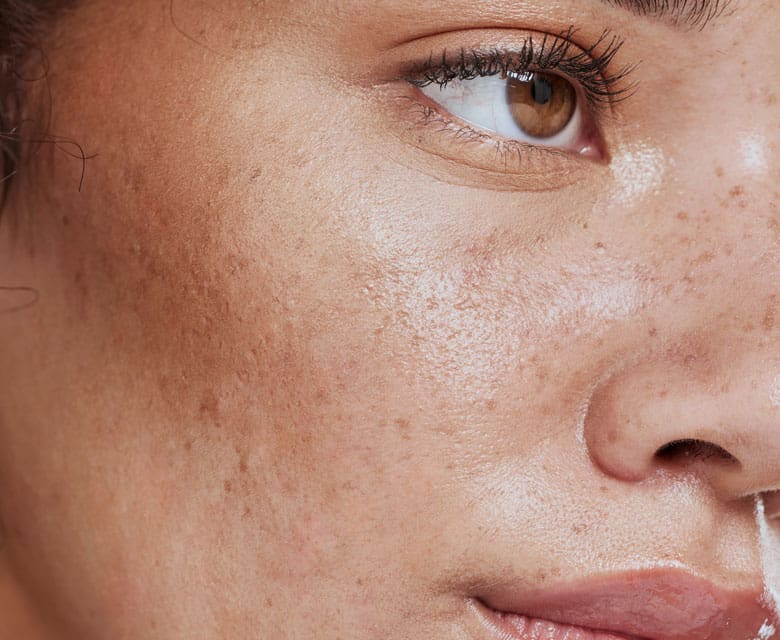 MAESKN Aesthetics - Sebaceous hyperplasia