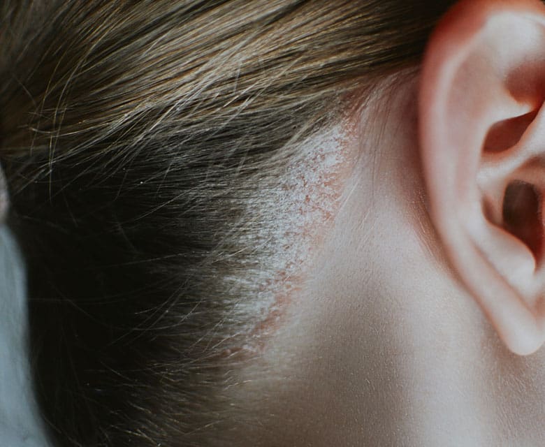 MAESKN Aesthetics - psoriasis