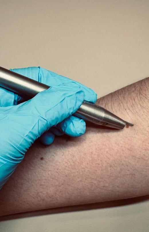 MAESKN Aesthetics - Benign Skin Leisons