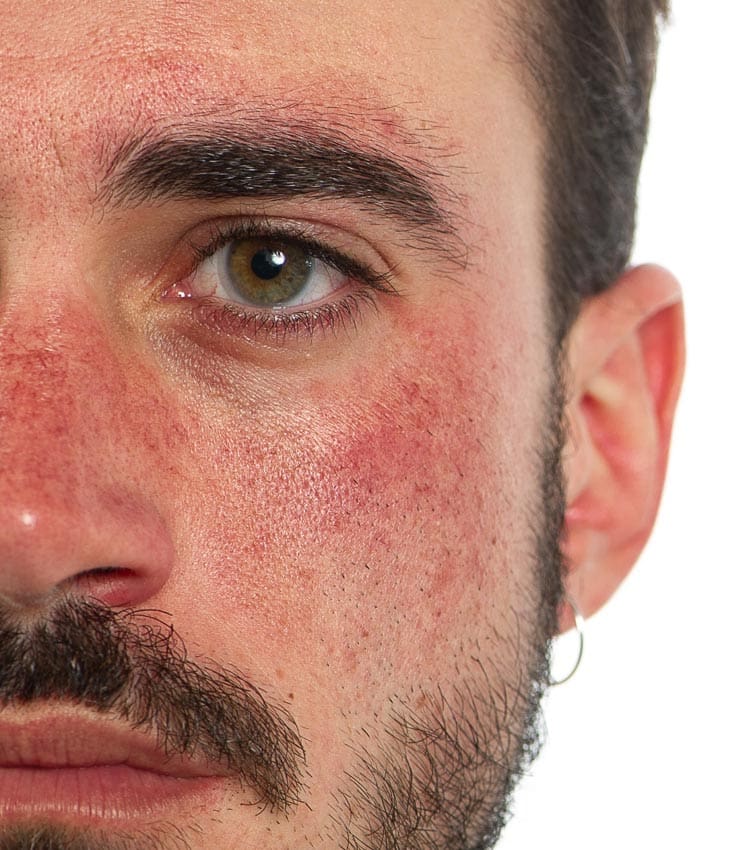 MAESKN Aesthetics - Facial Thread Veins 2