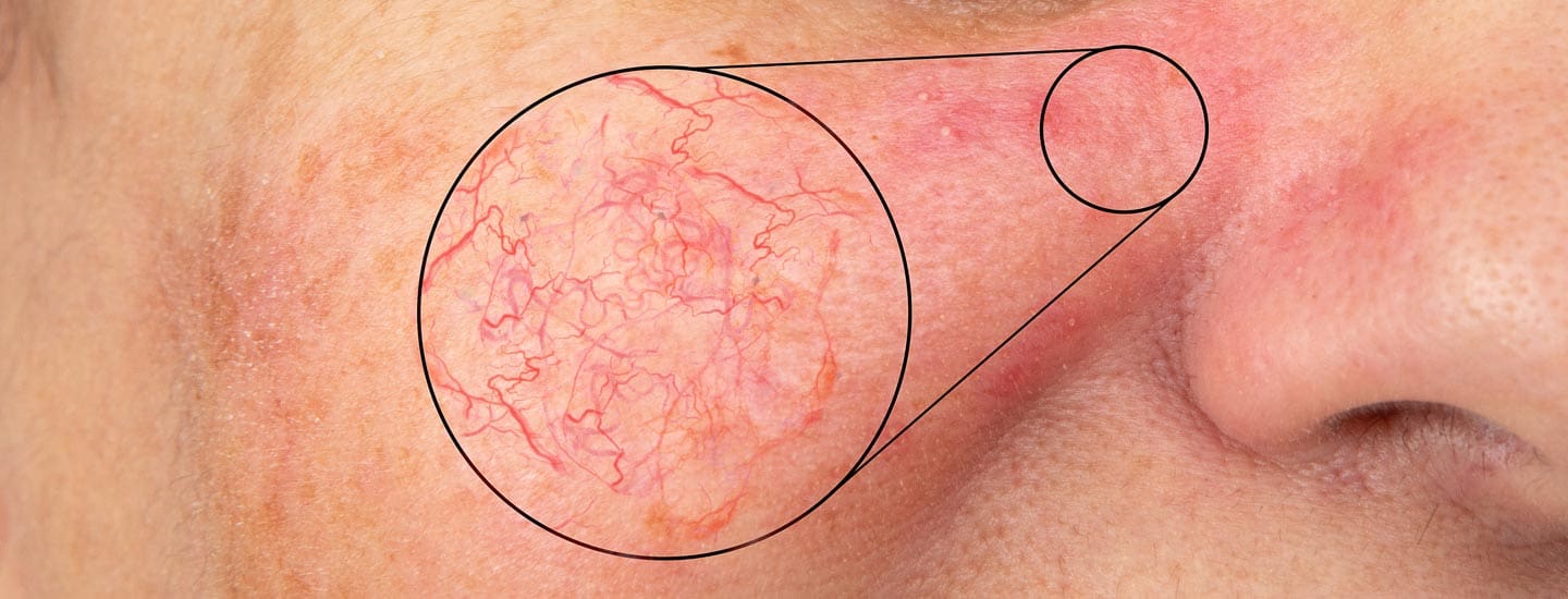 MAESKN Aesthetics - Facial Thread Veins