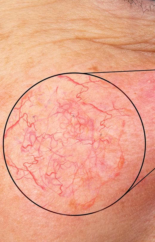 MAESKN Aesthetics - Facial Thread Veins