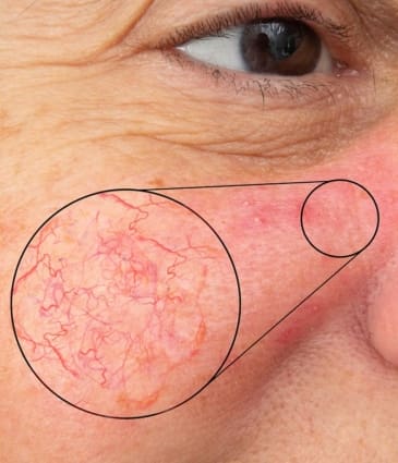 MAESKN Aesthetics - Facial Thread Veins