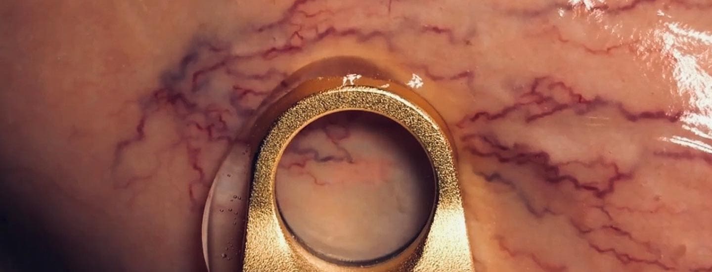 MAESKN Aesthetics - Leg Veins