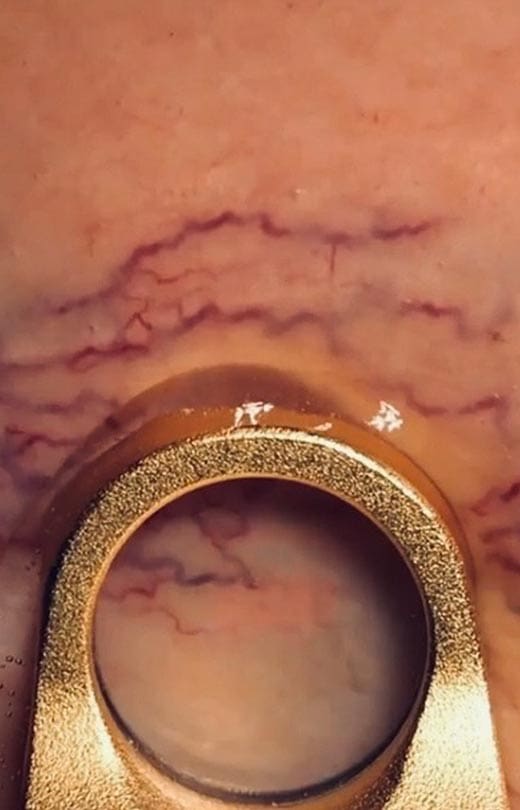 MAESKN Aesthetics - Leg Veins