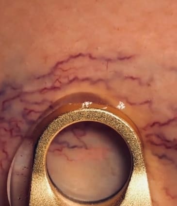 MAESKN Aesthetics - Leg Veins