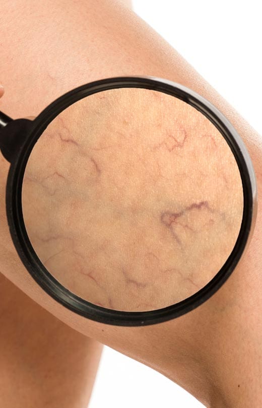 MAESKN Aesthetics - Leg vein consultation